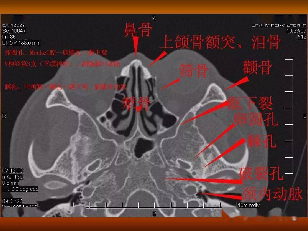 颅骨外伤性骨折ct诊断