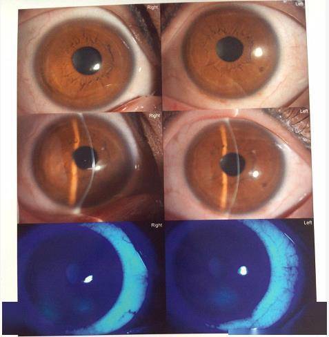 戴眼镜都看不清楚体育老师患圆锥角膜险失明