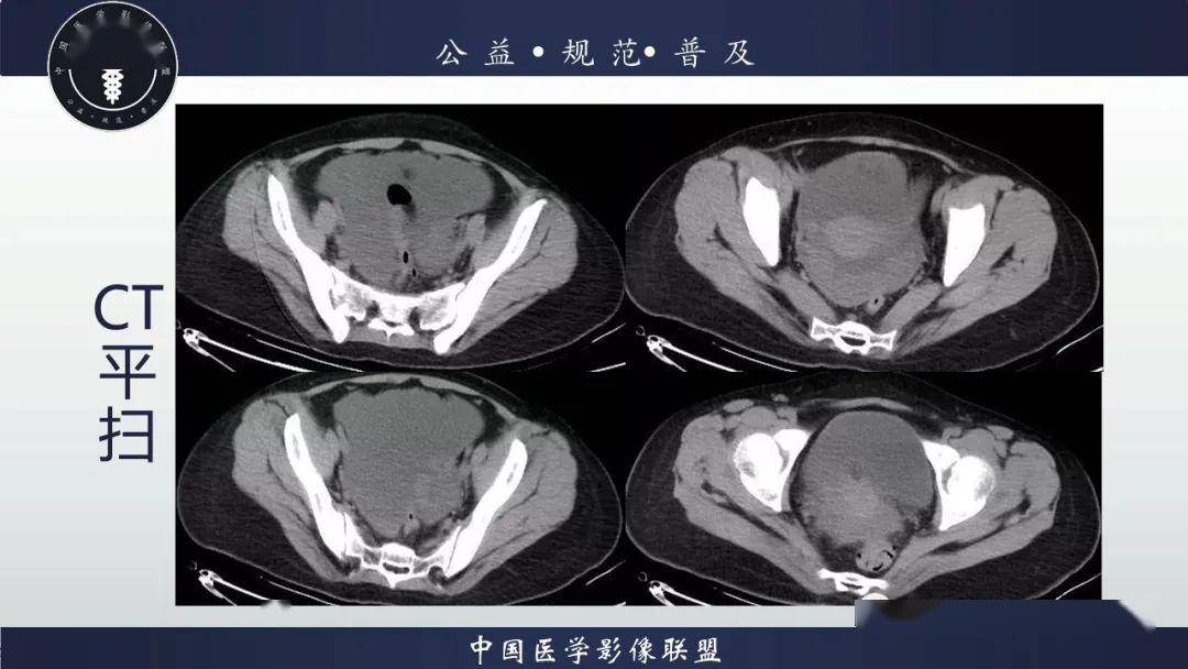 盆腔丨盆腔腺泡状横纹肌肉瘤