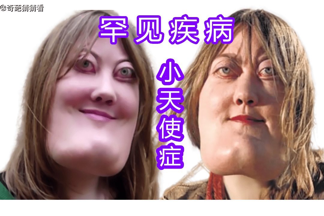 小天使症:一种极为罕见的疾病,致使人脸部严重变形_疾病_脸部_小天使