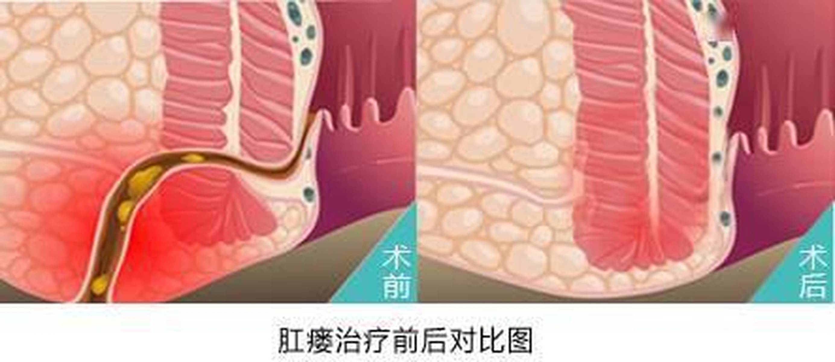 肛瘘治疗