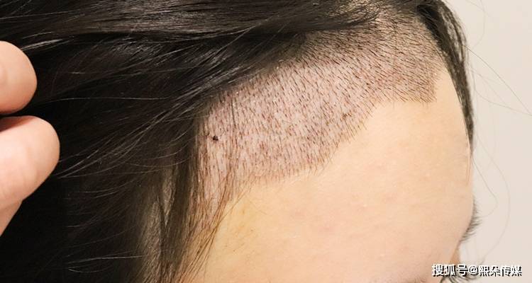 熙朵李会民aht植发技术完美解决女性两鬓头发稀少问题