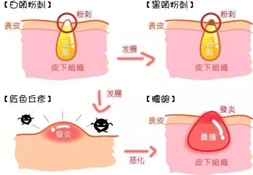 皮肤长痘痘怎么办