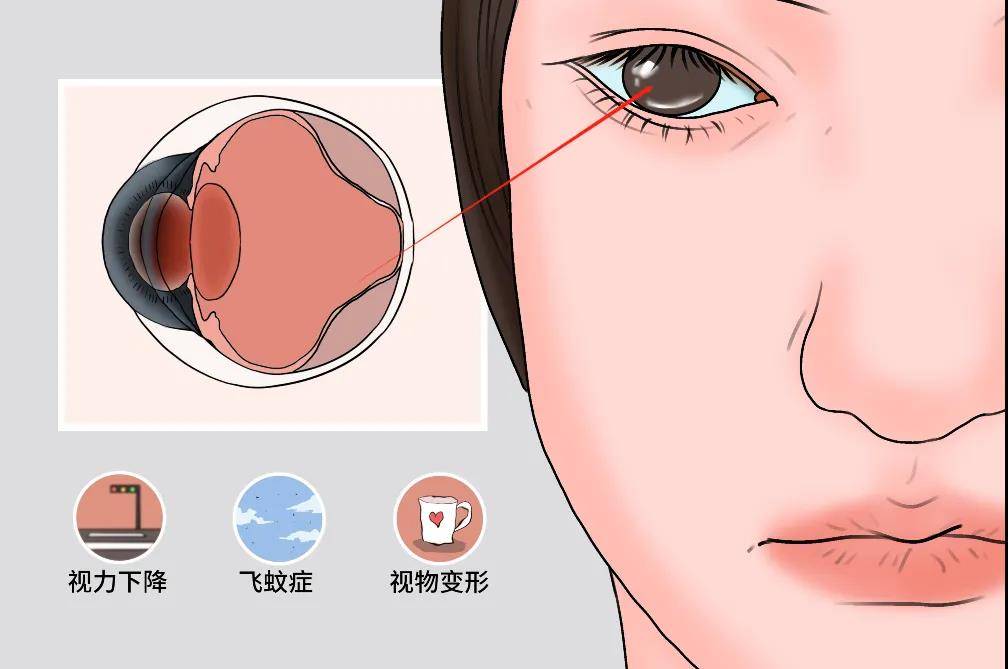 眼外伤导致的视网膜脱离还能治好吗