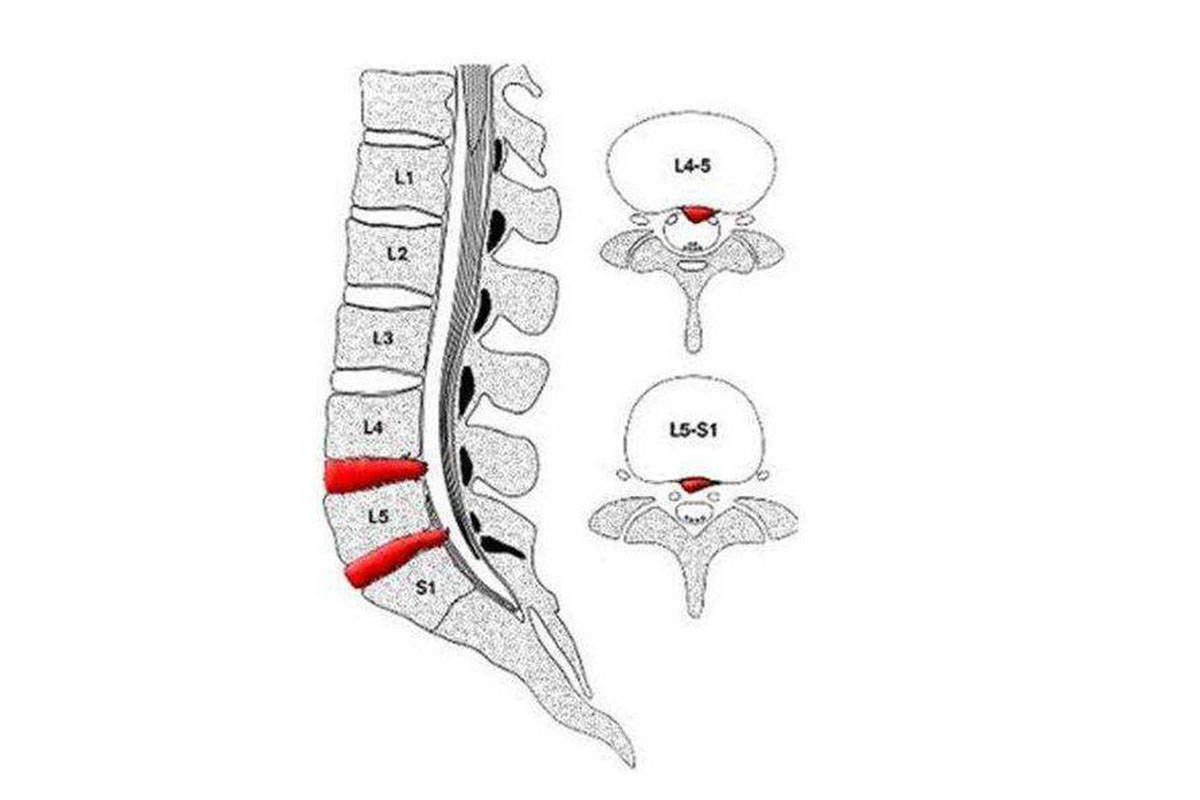 腰椎间盘突出中央型图图片