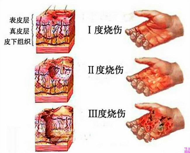 二级烧伤是什么程度图片