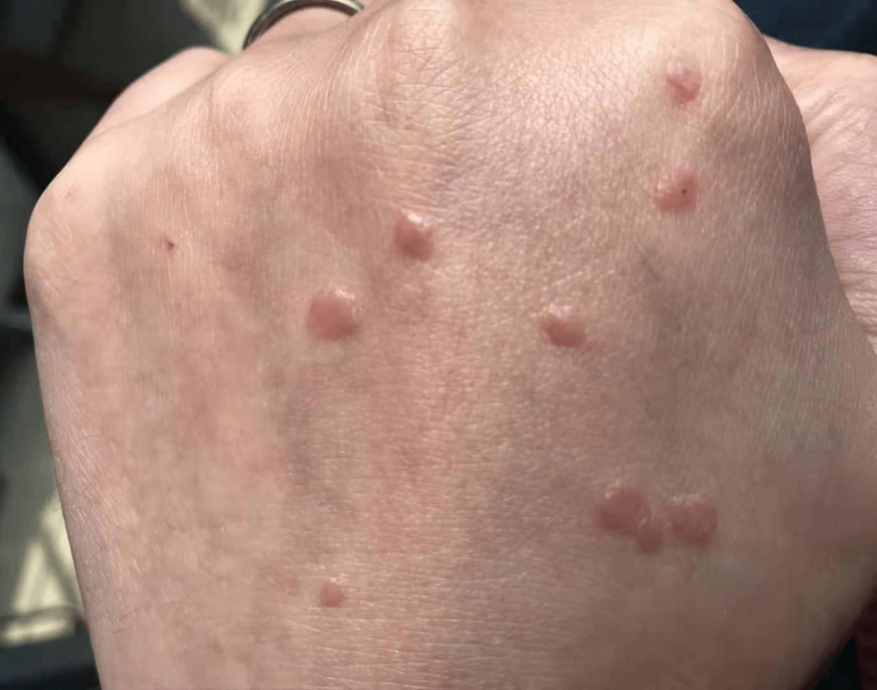 祛疣治疗——激光和冷冻应该如何选择?