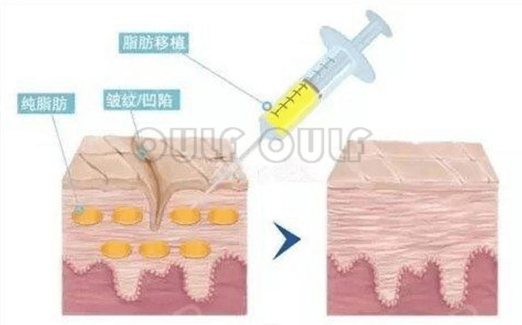 永久|脂肪胶填充是永久的吗