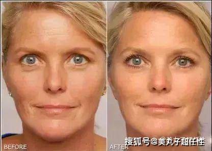 解决方案|最真实的抬头纹解决方案,看懂了不花冤枉钱