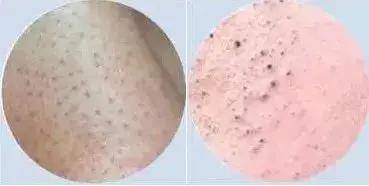 方法|最火的几种去黑头的方法，求求你千万不要再做了！