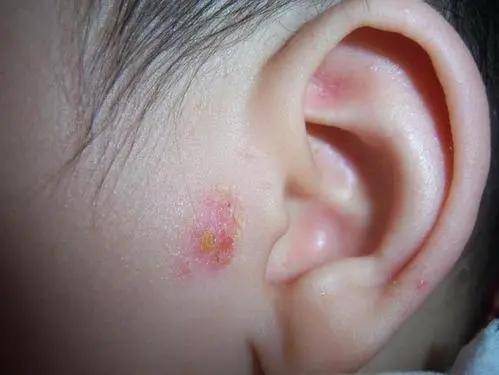 耳朵的湿疹怎么办啊