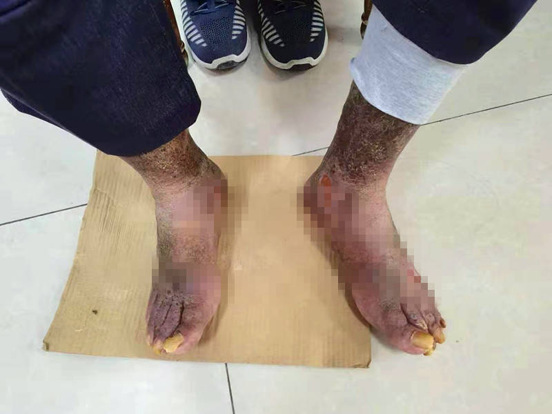 住院|不手术不住院，一招就能根治静脉曲张，西安这家诊所先签约后治疗