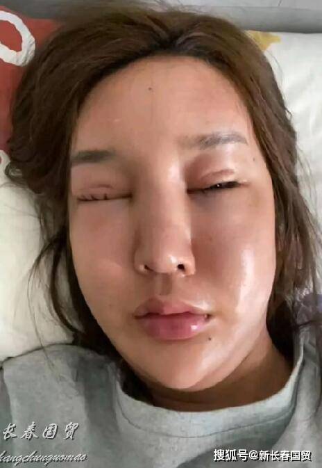 脸部|女网红8年疯狂整容上千次，如今出现后遗症：脸部凹陷畸形眼晴睁不开