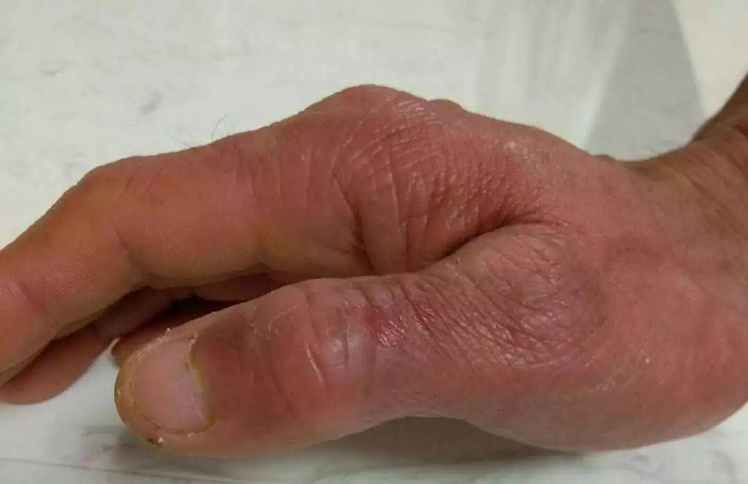 长春肤康医院接触性皮炎应如何预防