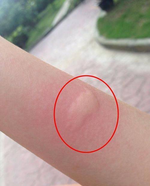 原创花蚊子该灭绝了吧咬得人生疼如今终于找到解决办法