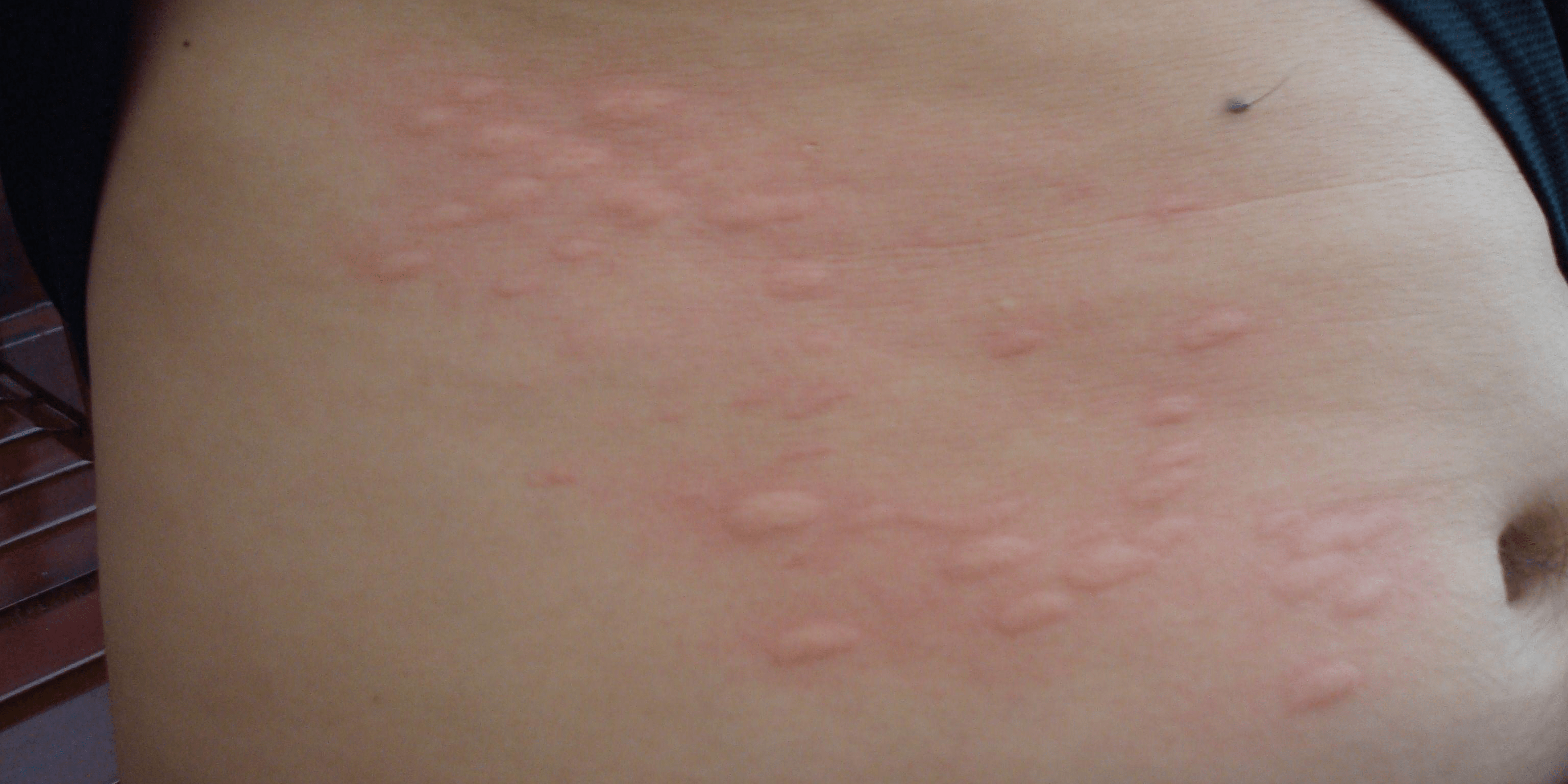 湿疹是什么症状