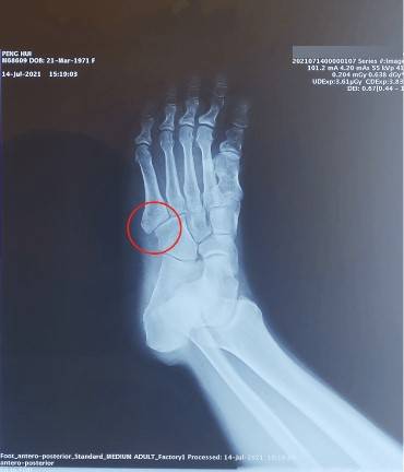 北京素兰医疗诊所第五跖骨骨折案例分享