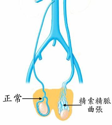 睾丸蚯蚓状图片图片