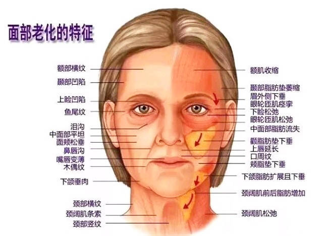 进行|李方奇谈:抗衰面部提升有哪些项目？小切口提升效果如何