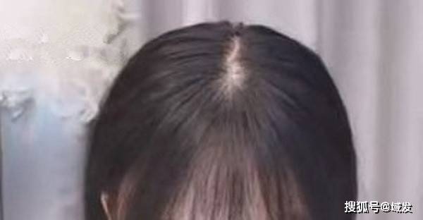 发缝宽算不算脱发？还能恢复吗？_头发