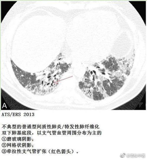 特发性 间质性肺炎 有什么药能治 临床