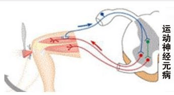 治疗|运动神经元病患者就一定是“渐冻人”吗？