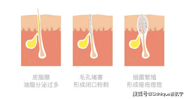 毛囊|各类痘痘的解决方案，别让无知毁了你的颜值