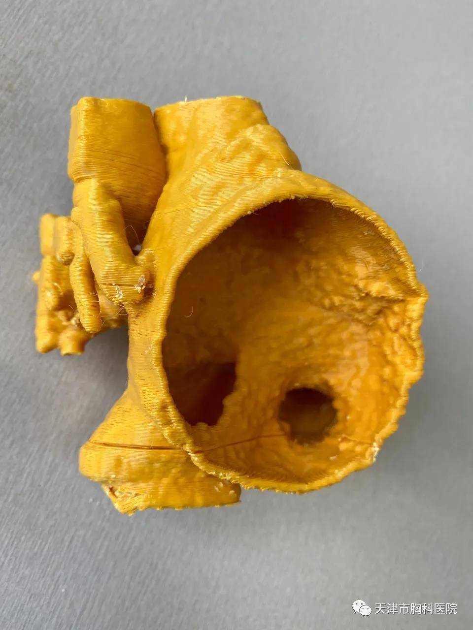 胸科医院|这种疾病只能开胸治疗？天津首例下腔型房间隔缺损介入封堵术在胸科医院完成！