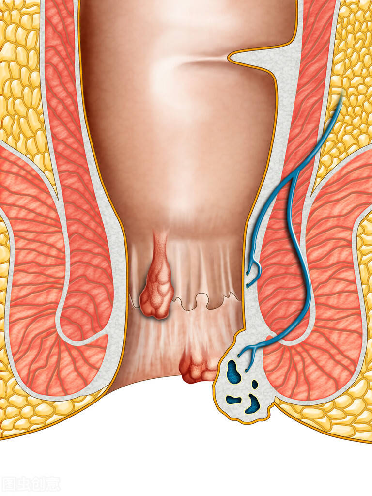 肛瘘和痔疮的区别图片