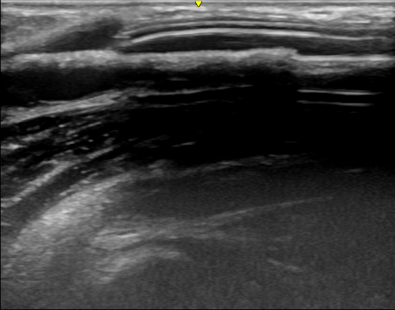 覆膜|西安交大一附院肾脏内科实施陕西省首例超声引导下透析通路支架植入术