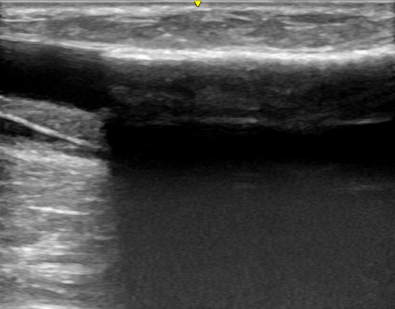 覆膜|肾脏内科实施陕西省首例超声引导下透析通路支架植入术