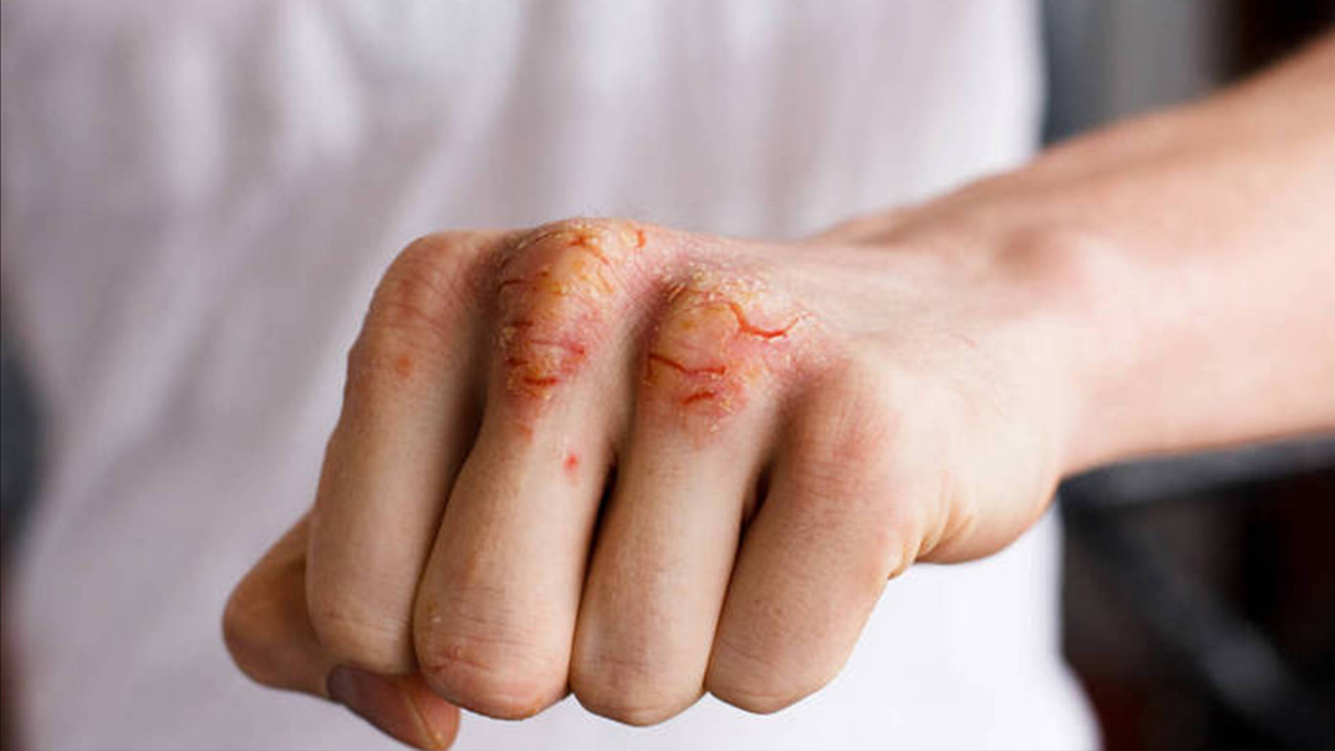 长春肤康医院浅谈:湿疹和其他皮肤病分不清?