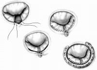 治疗|反复发烧2个多月，17岁女孩患的这种少见病经高难手术精巧治愈