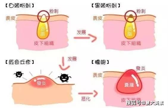 治疗|闭口粉刺会自动消失吗？不会！ 掌握这三点，痘痘问题不在惧