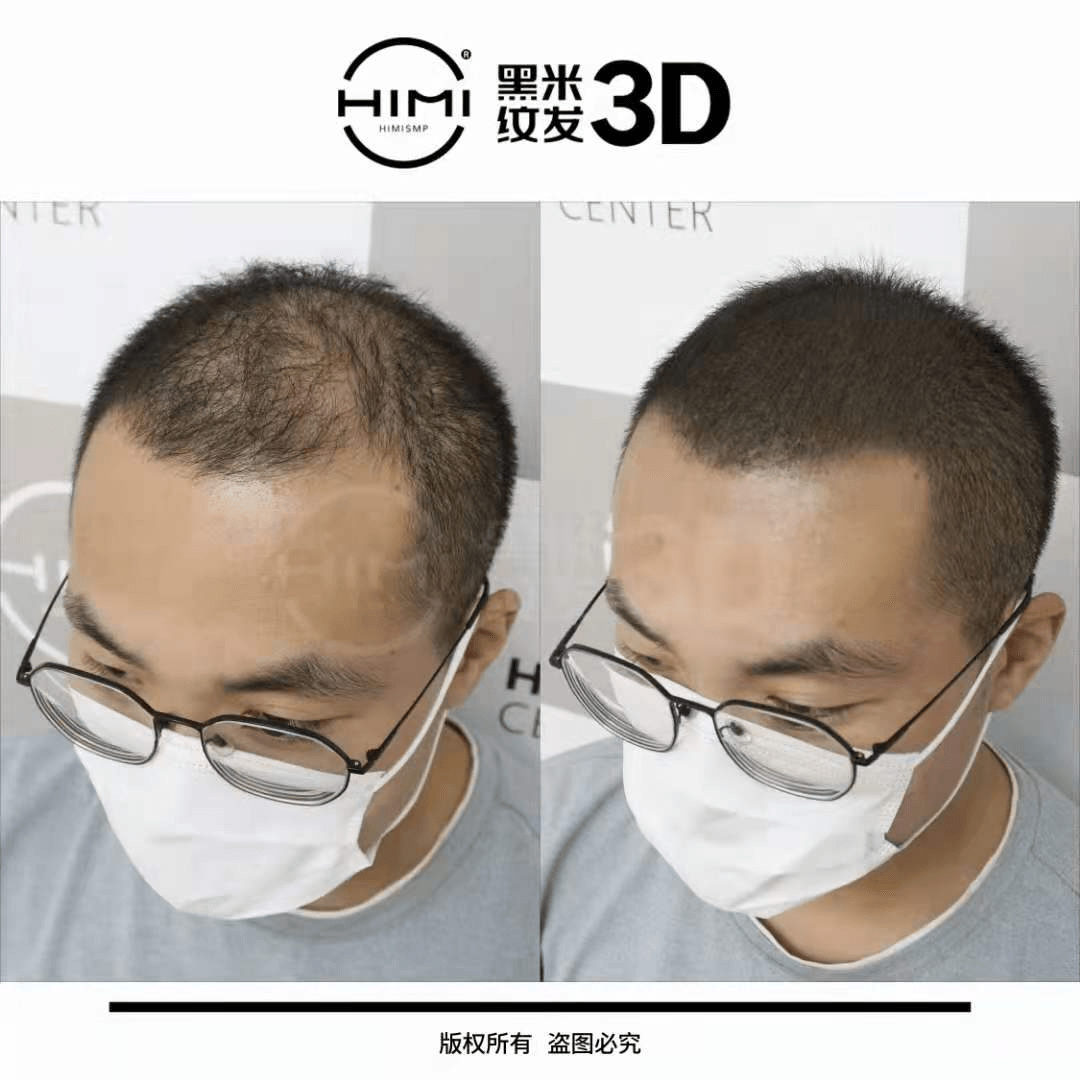 表皮层|黑米3D纹发：3D纹发真的看不出来吗，会不会再生长？