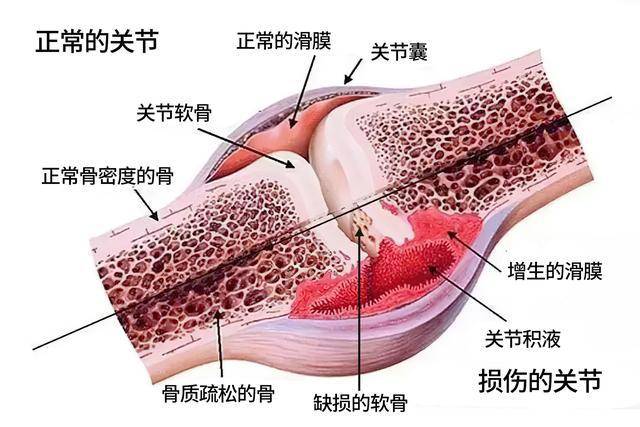 膝盖骨结构彩色示意图图片