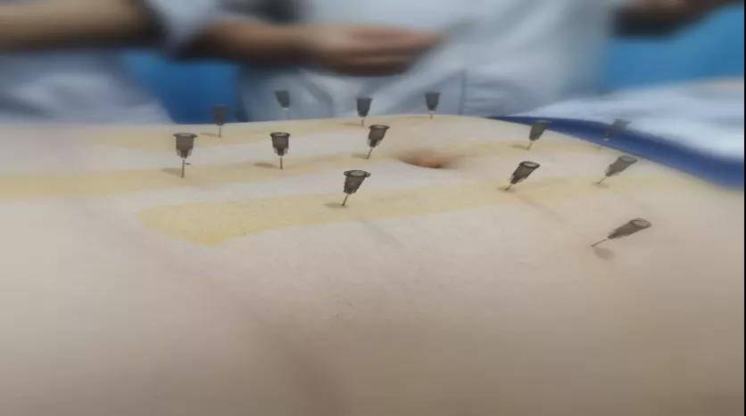 小伙子|丨康复馆丨现代都市人首选减肥法——埋线减肥