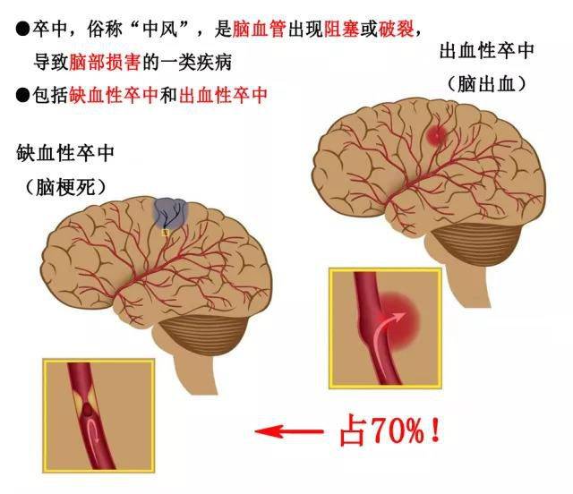 为什么脑卒中不再是老年人的专利,青壮年患病人数逐年升高,该怎么预防