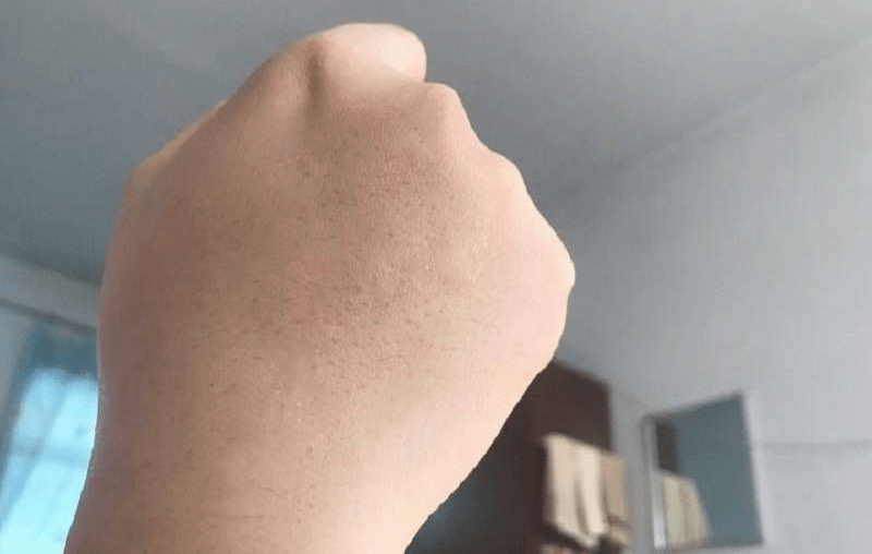 疱疹怎么治疗才好快 fb6bbaed0a2140cd8c451abdacb027ec.png