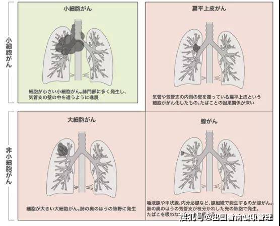 肺癌的分型和相应的特点 肺癌康复圈 觅健