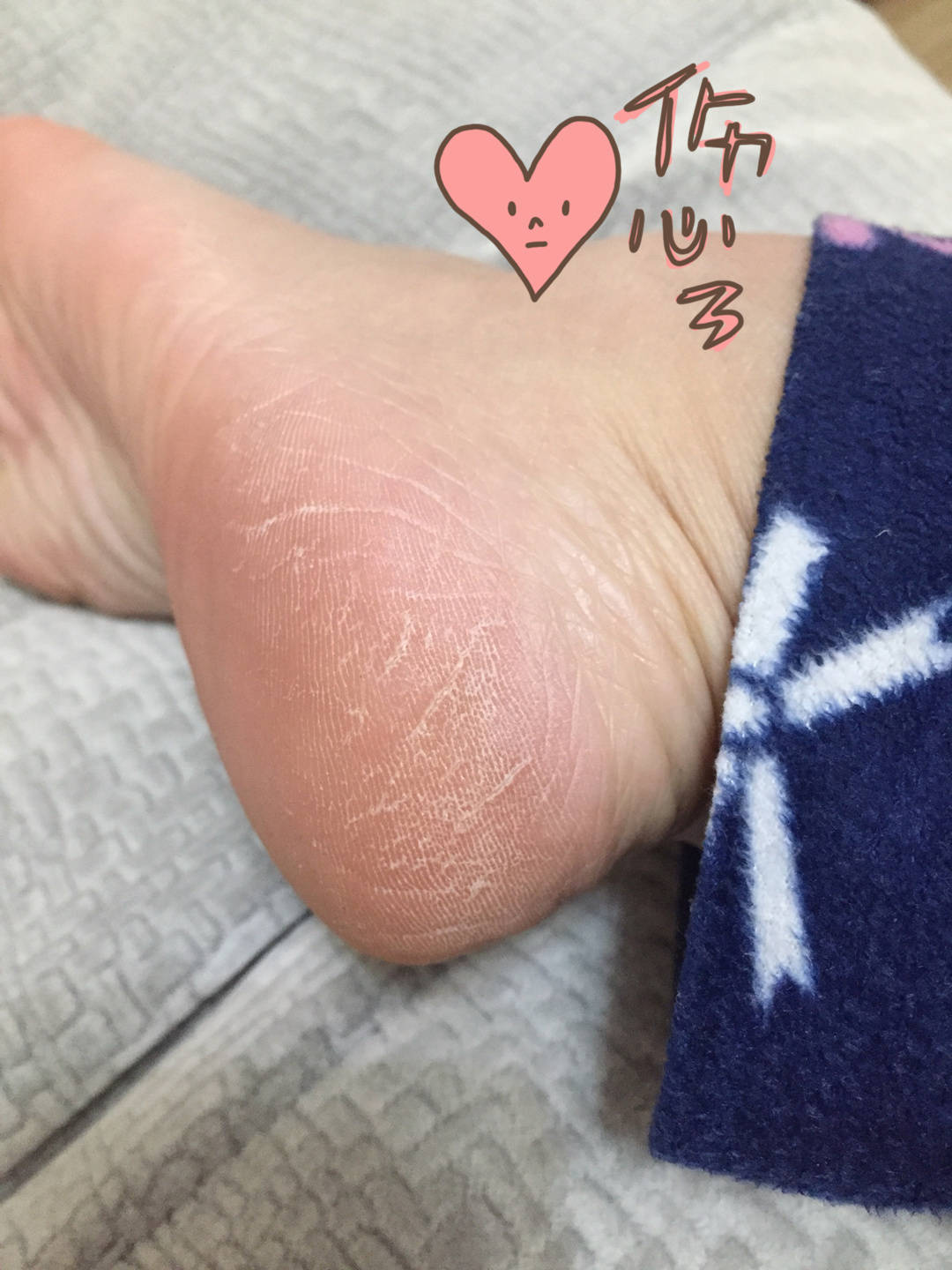 脚后跟像砂纸一样粗糙?怎么回事呀?
