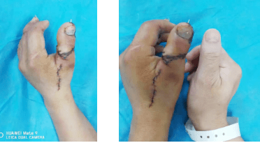 髂骨|咸阳市中心医院手足外科成功完成一例复杂拇指再造术