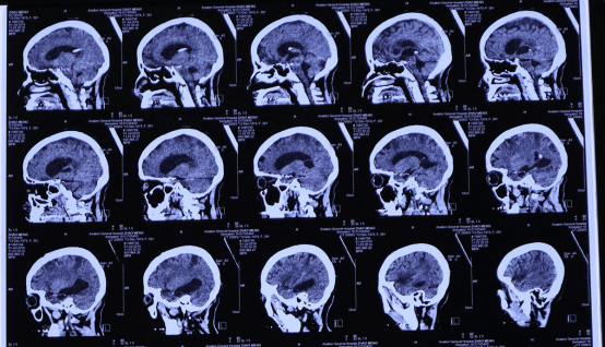 航空总医院脑脊液科成功救治一位危重颅内感染患者