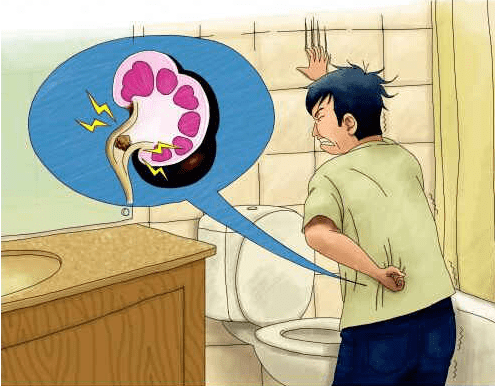 症状|肾结石有什么症状