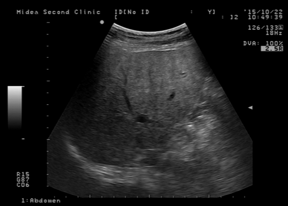 肝脏|肝癌多是“吃”出来的？医生：身体若有4种异常，肝脏或已“千疮百孔”