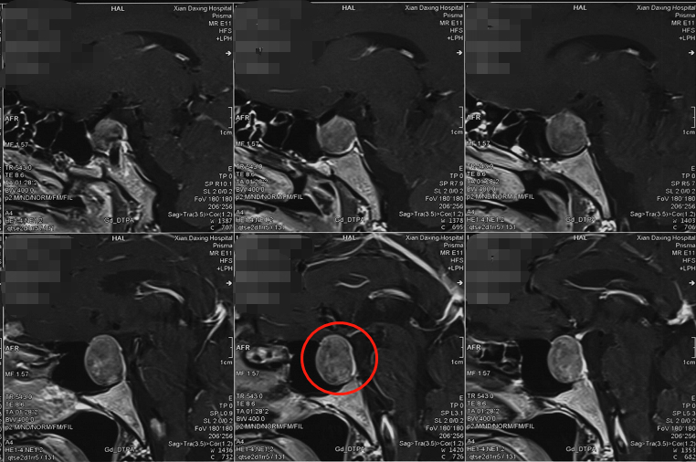 治疗|44岁加拿大华人万里求医，神外专家妙手除疾！