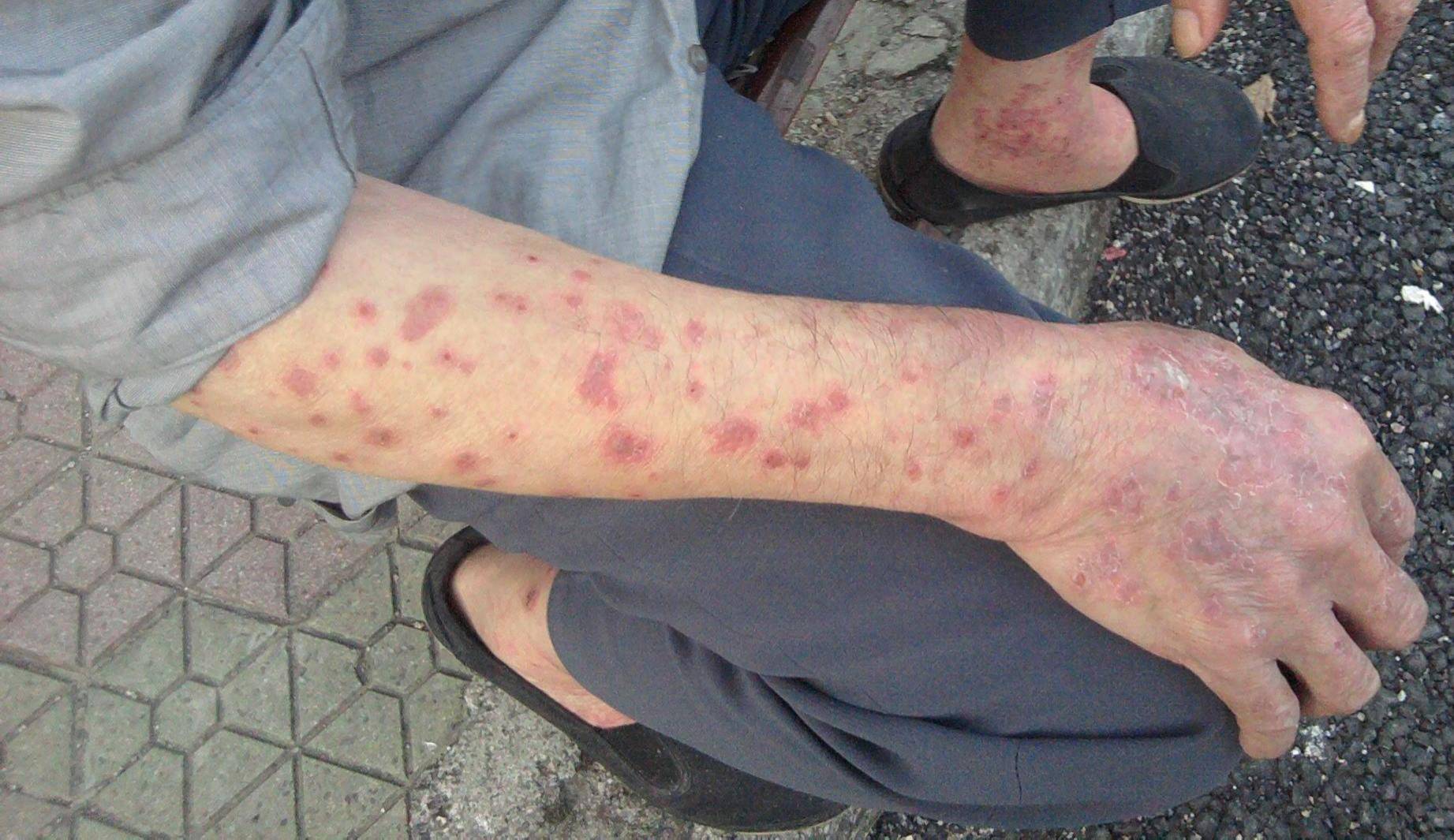 长春肤康医院浅谈晒太阳对牛皮癣患者有何影响