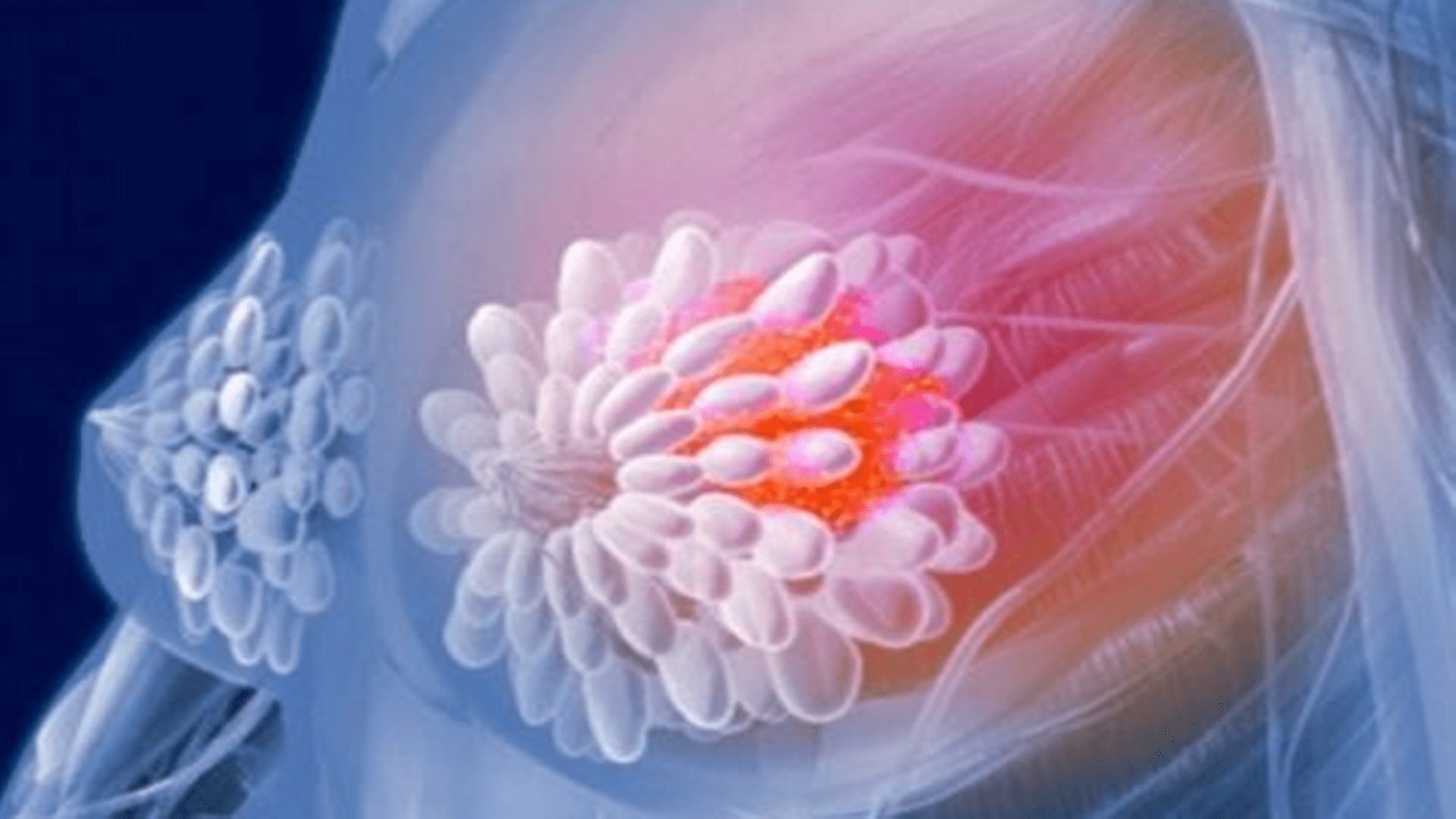 关爱|早期乳腺癌能自查，不要拖到中晚期，但80%的人错过了最佳时间