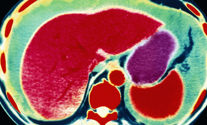 肝脏|医生提醒：这3种蔬菜被列入肝病“黑名单”，有肝病的人要少吃