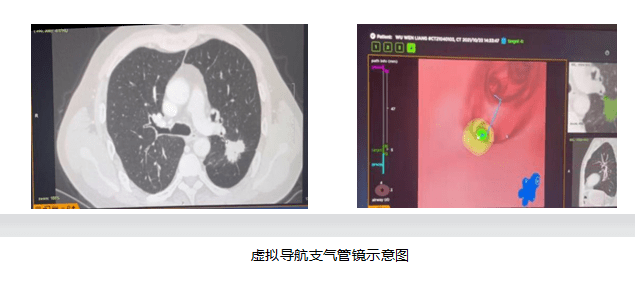 步伐|西安交大一附院东院区呼吸内科团队紧跟融合发展步伐 开展多项先进医疗技术